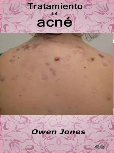 Portada de Tratamiento Del Acné, de Owen Jones