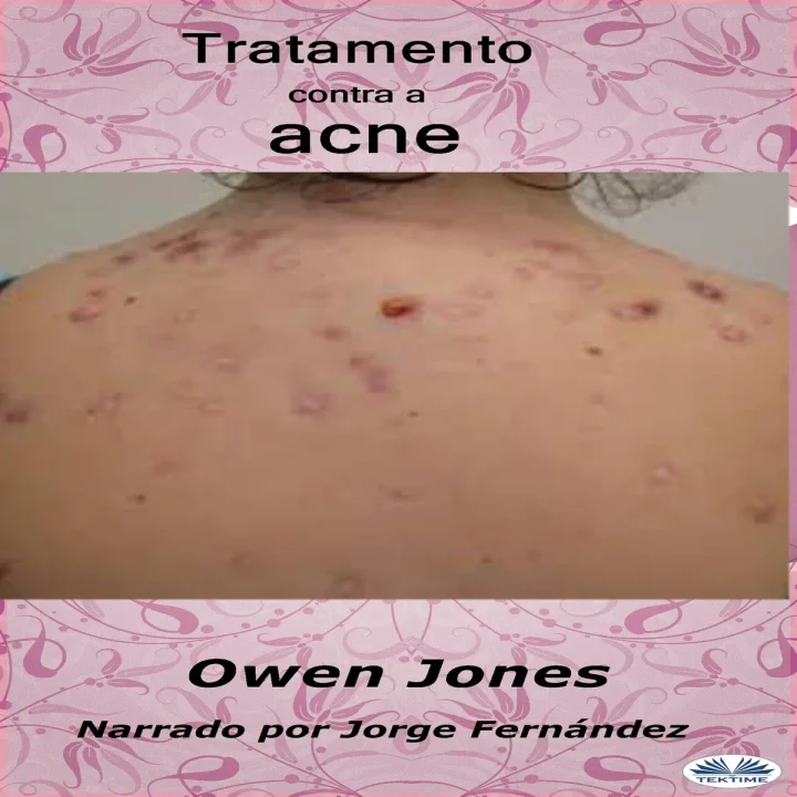 Portada de Tratamiento Del Acné, de Owen Jones